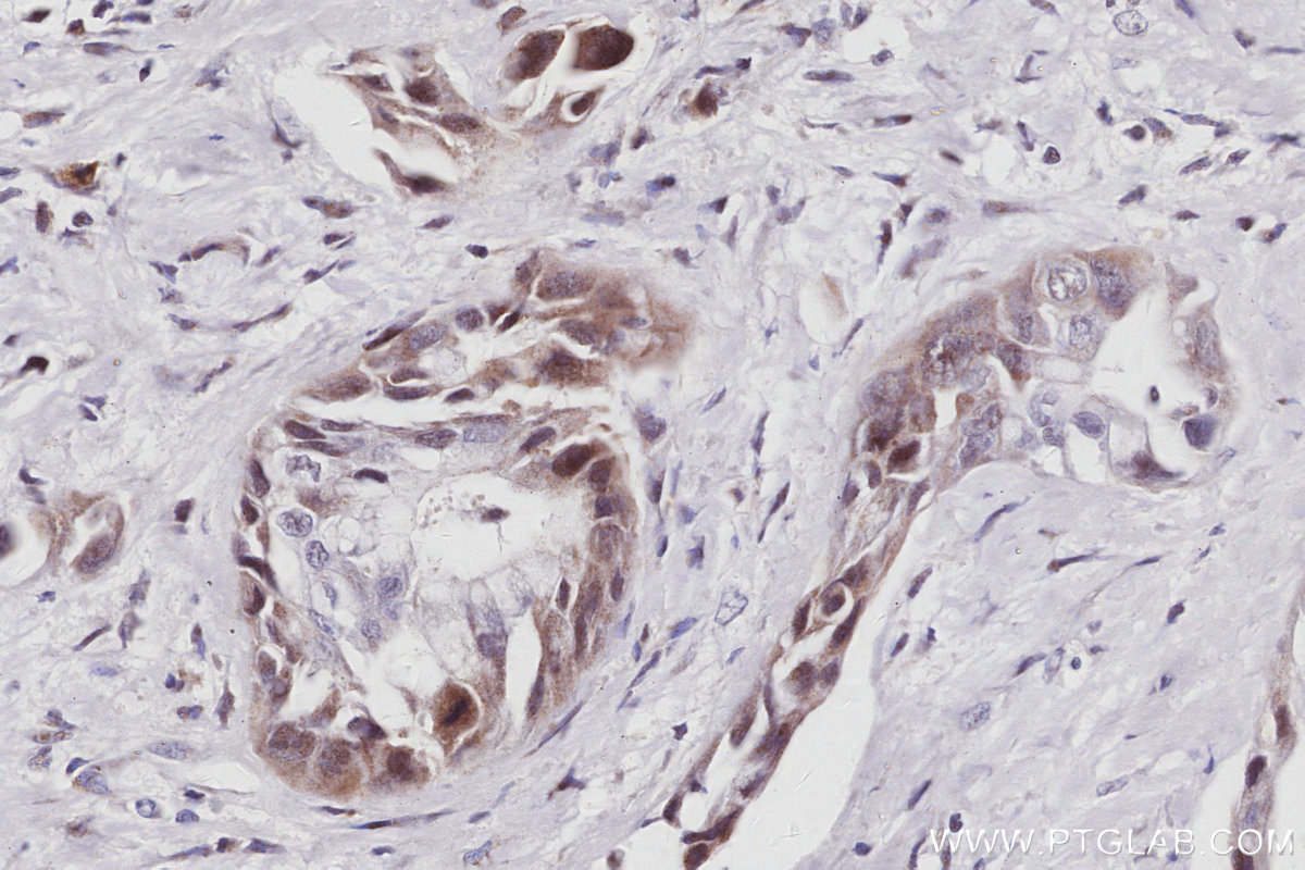 IHC staining of human pancreas cancer using 83117-4-RR IHC staining of human pancreas cancer using 83117-4-RR