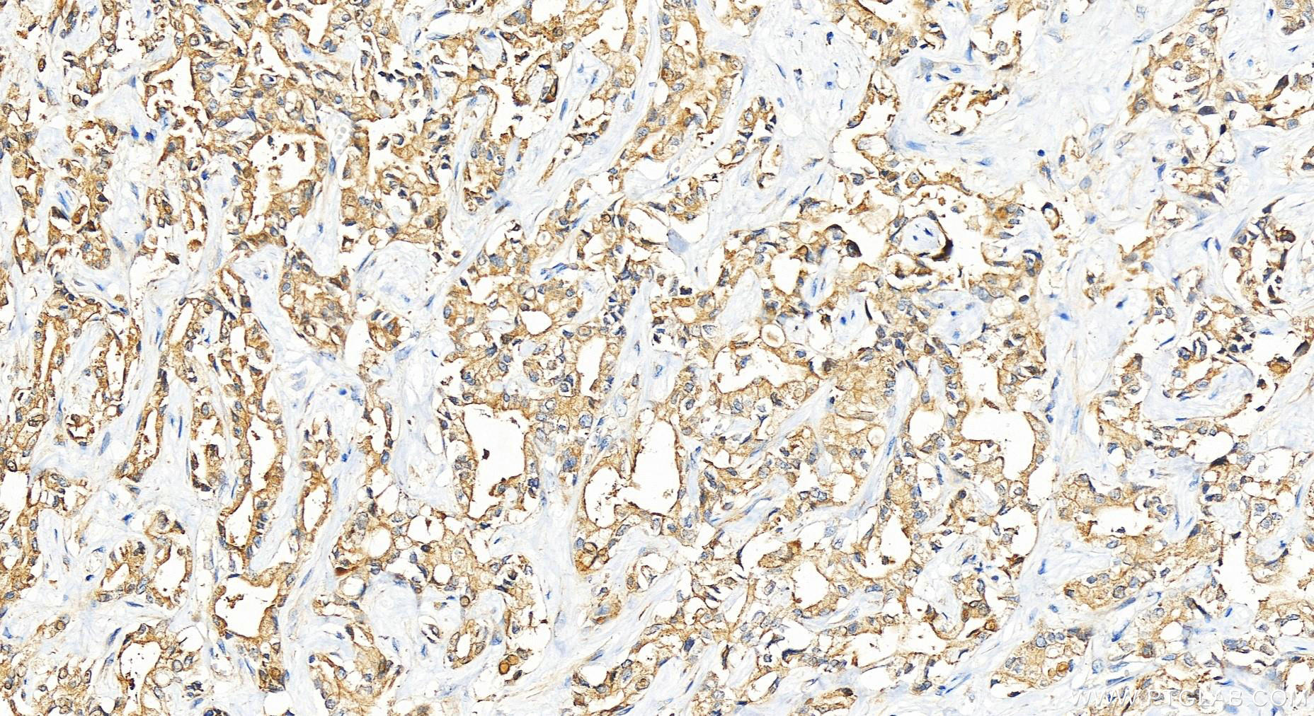 IHC staining of human intrahepatic cholangiocarcinoma using 12665-1-AP