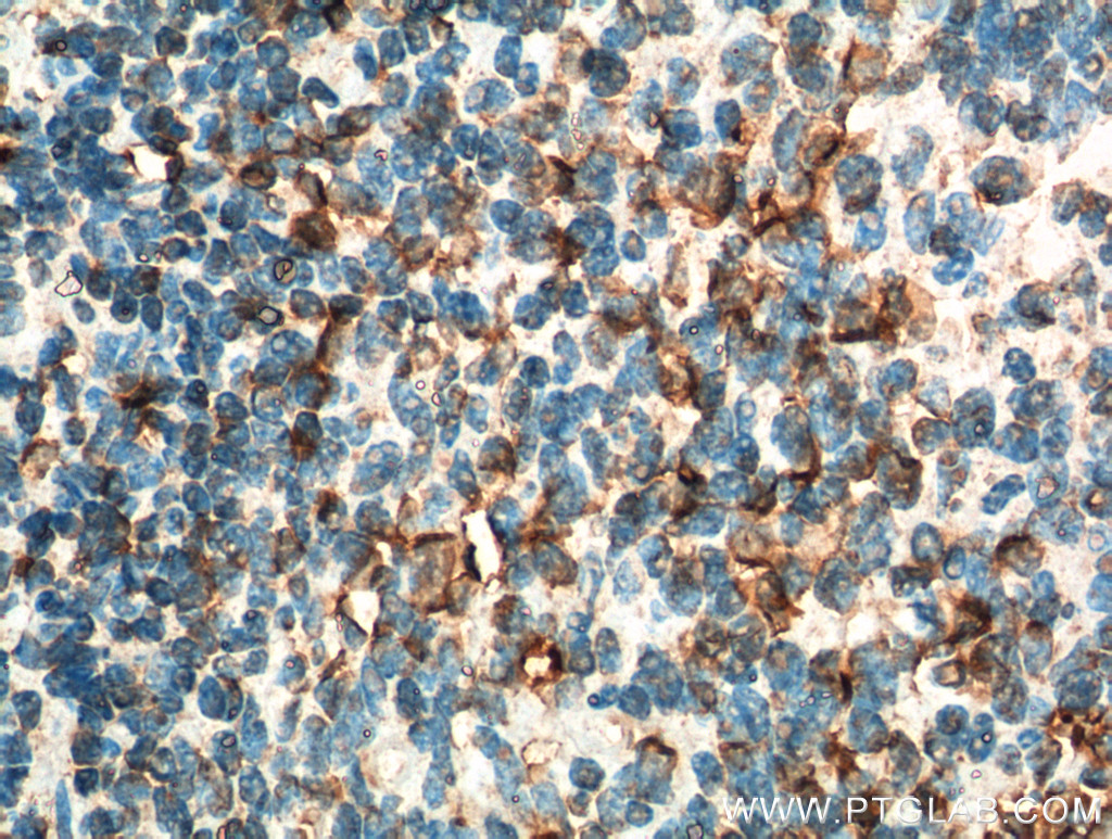 IHC staining of human tonsillitis using 19694-1-AP