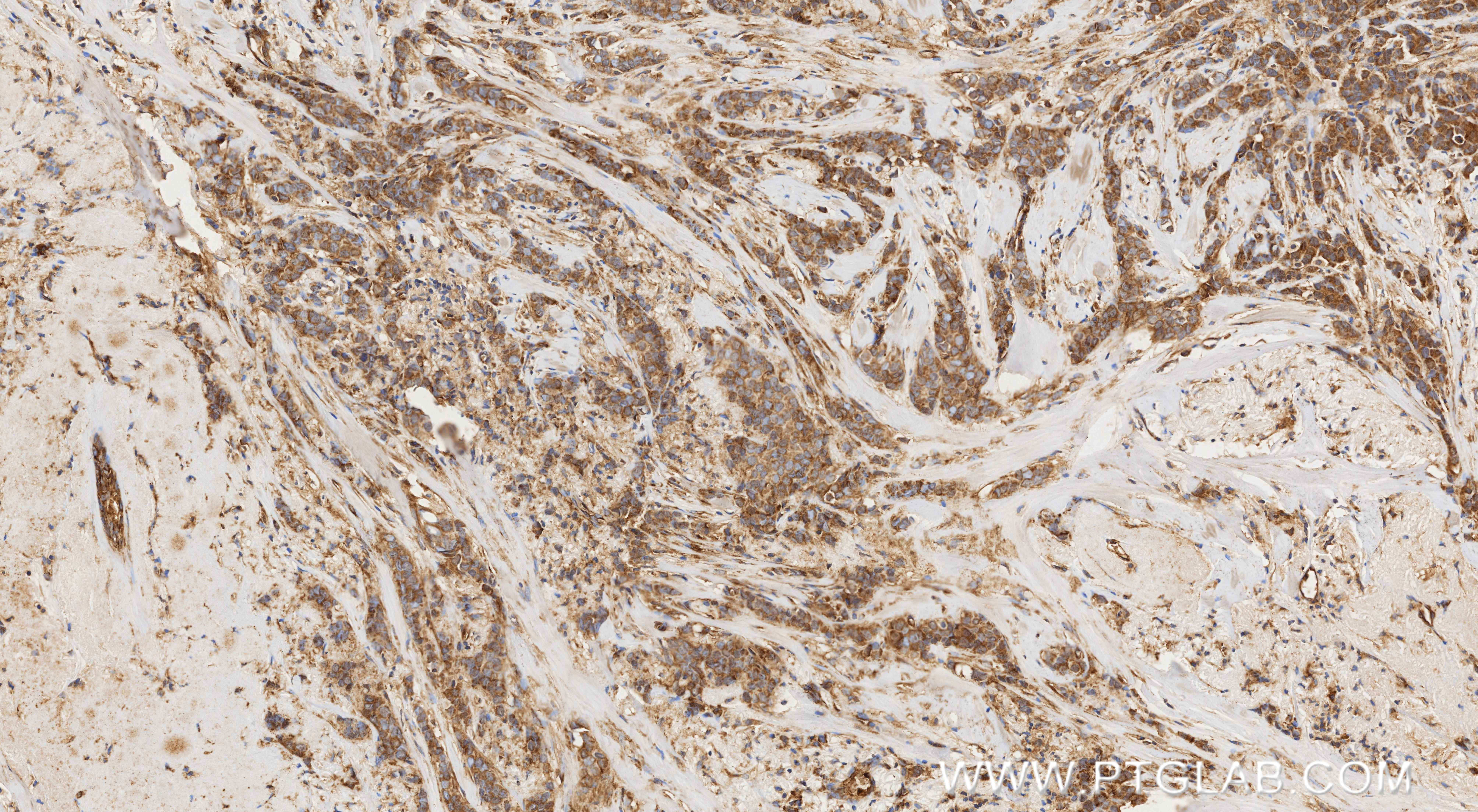 IHC staining of human breast cancer using 87161-1-RR