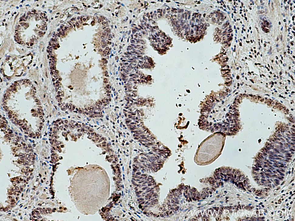 IHC staining of human prostate cancer using 14069-1-AP