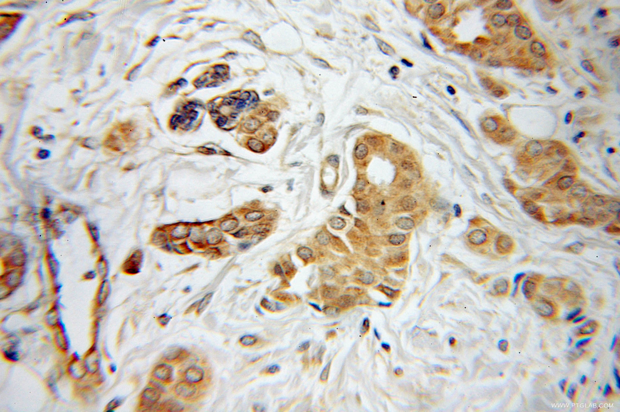 IHC staining of human breast cancer using 10585-1-AP