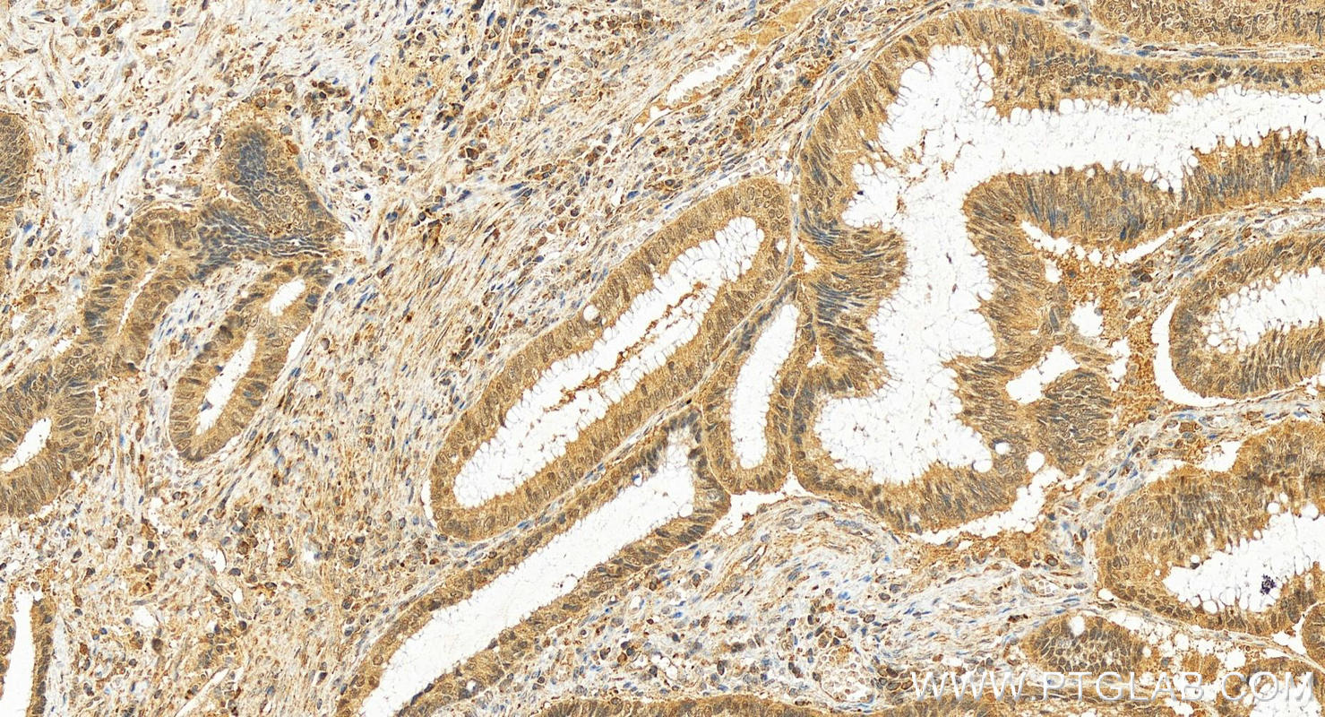 IHC staining of human colon cancer using 14403-1-AP