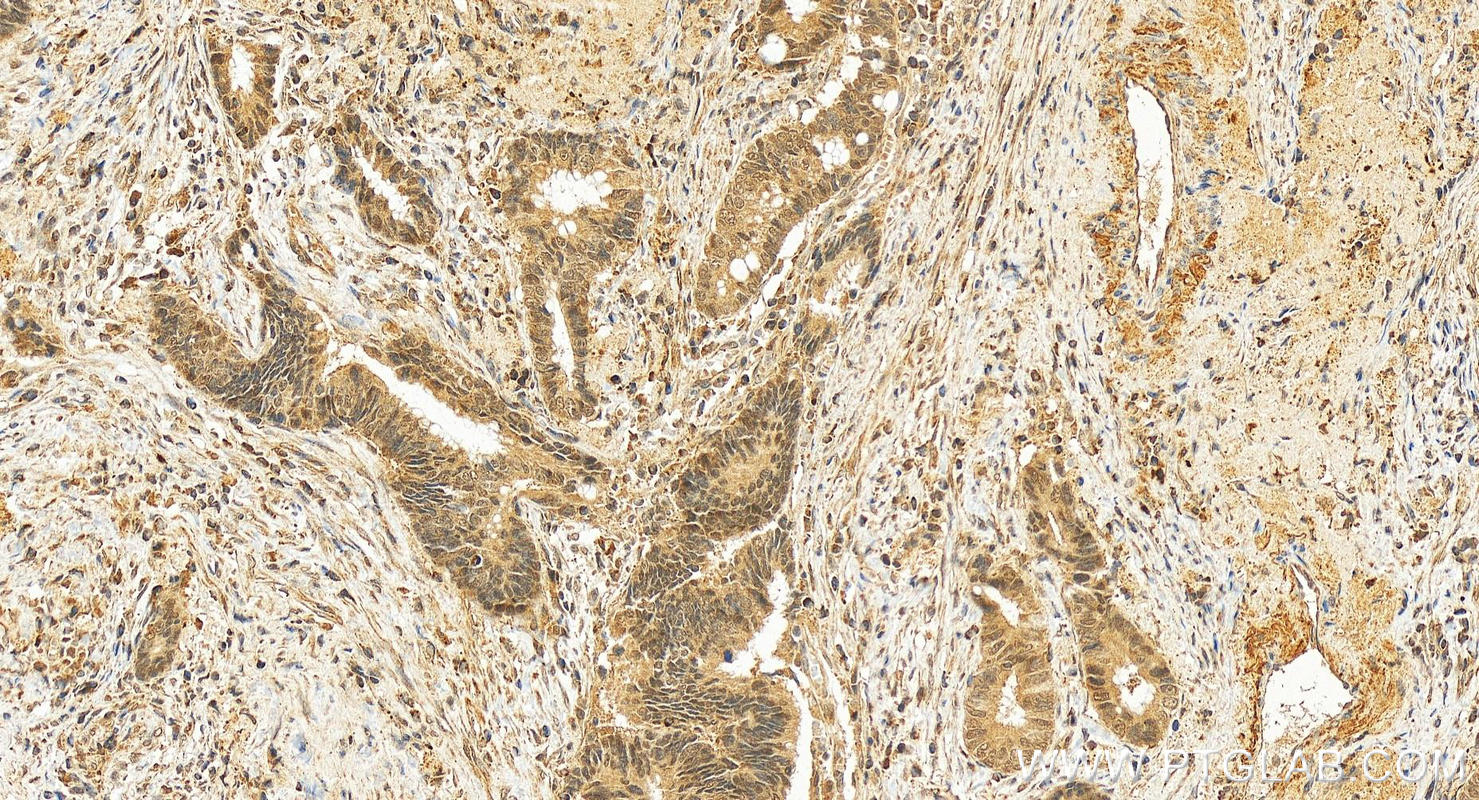 IHC staining of human colon cancer using 14403-1-AP