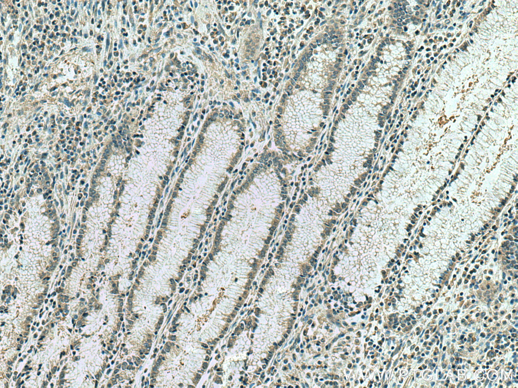 IHC staining of human stomach cancer using 67549-1-Ig