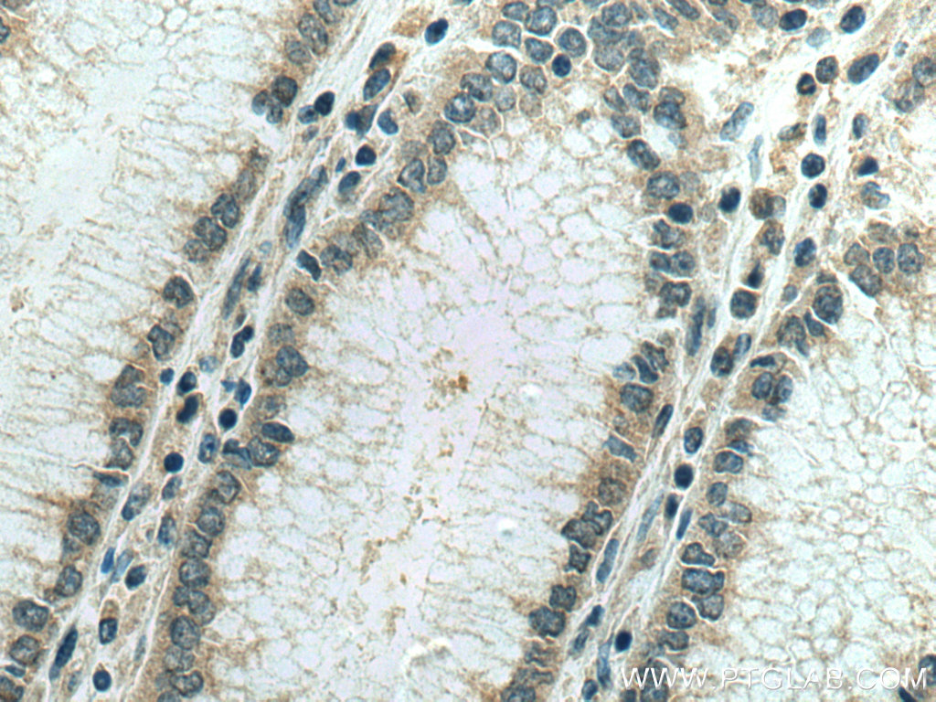 IHC staining of human stomach cancer using 67549-1-Ig