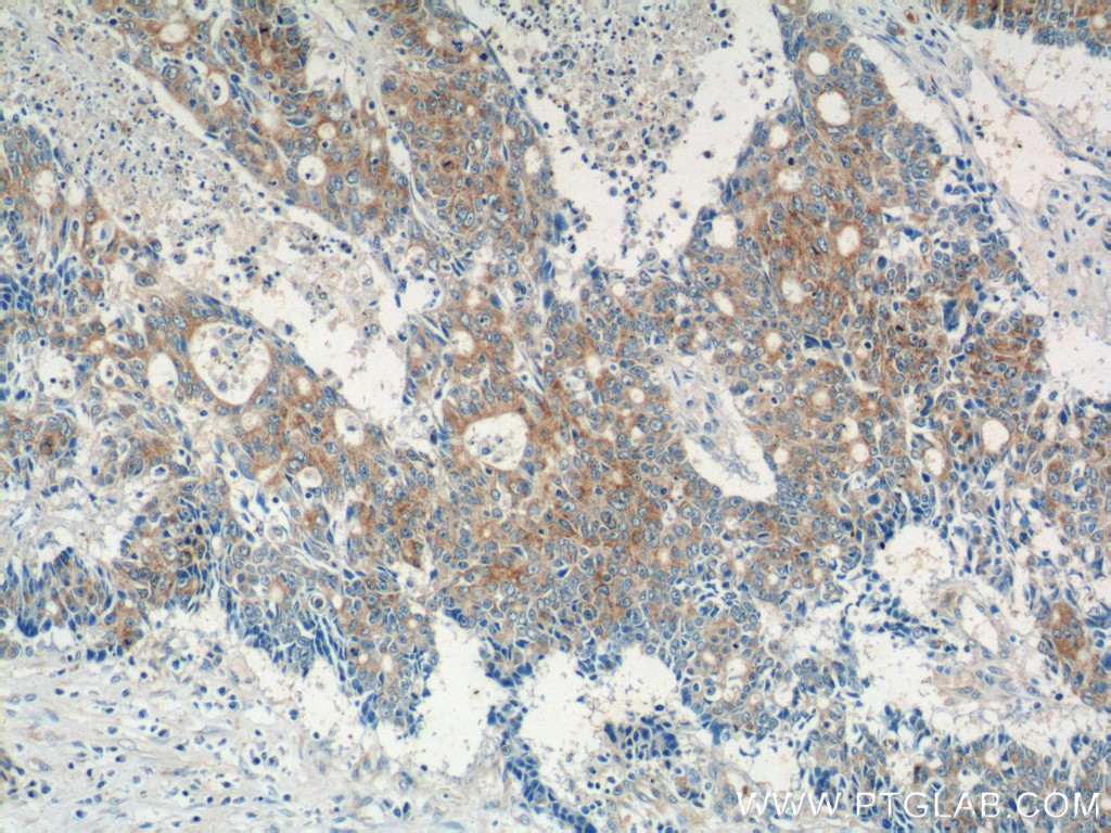 Immunohistochemical analysis of paraffin-embedded human colon cancer tissue slide using 25740-1-AP (IQCK Antibody) at dilution of 1:50 (under 10x lens). IHC staining of human colon cancer using 25740-1-AP