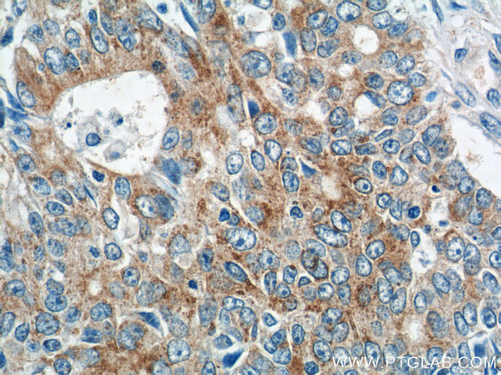 Immunohistochemical analysis of paraffin-embedded human colon cancer tissue slide using 25740-1-AP (IQCK Antibody) at dilution of 1:50 (under 40x lens). IHC staining of human colon cancer using 25740-1-AP