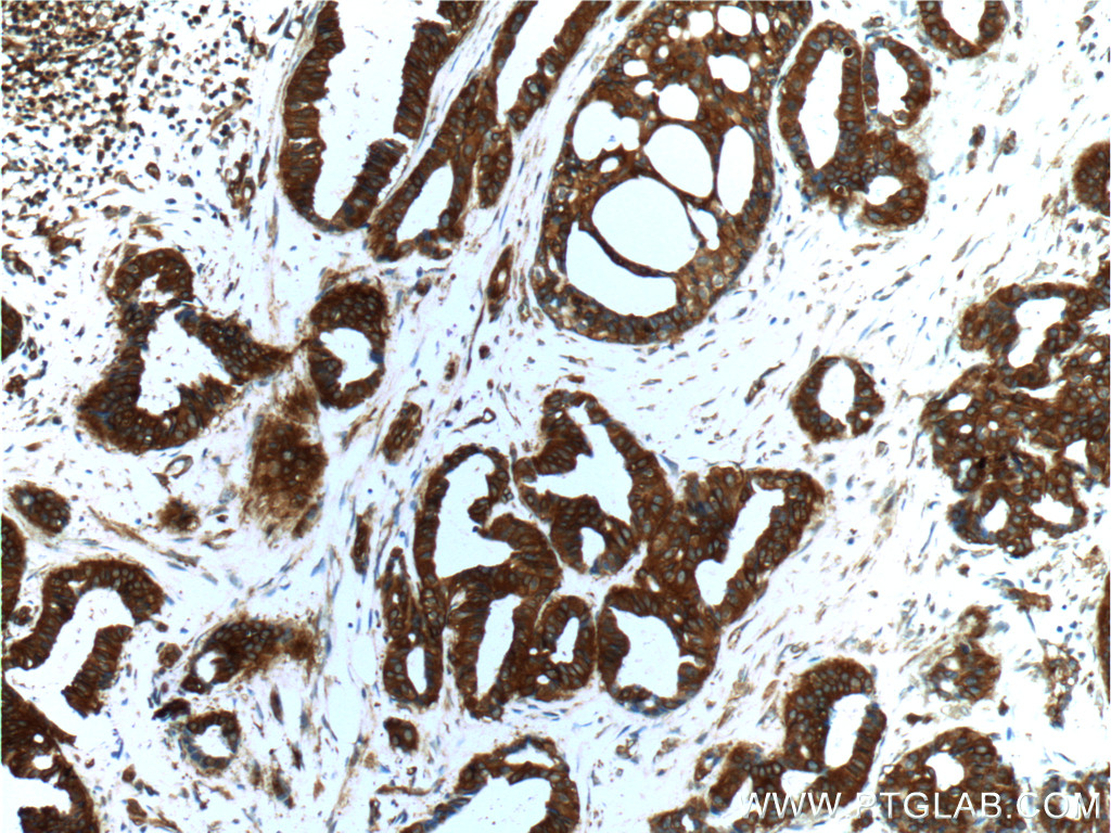 IHC staining of human breast cancer using 22167-1-AP