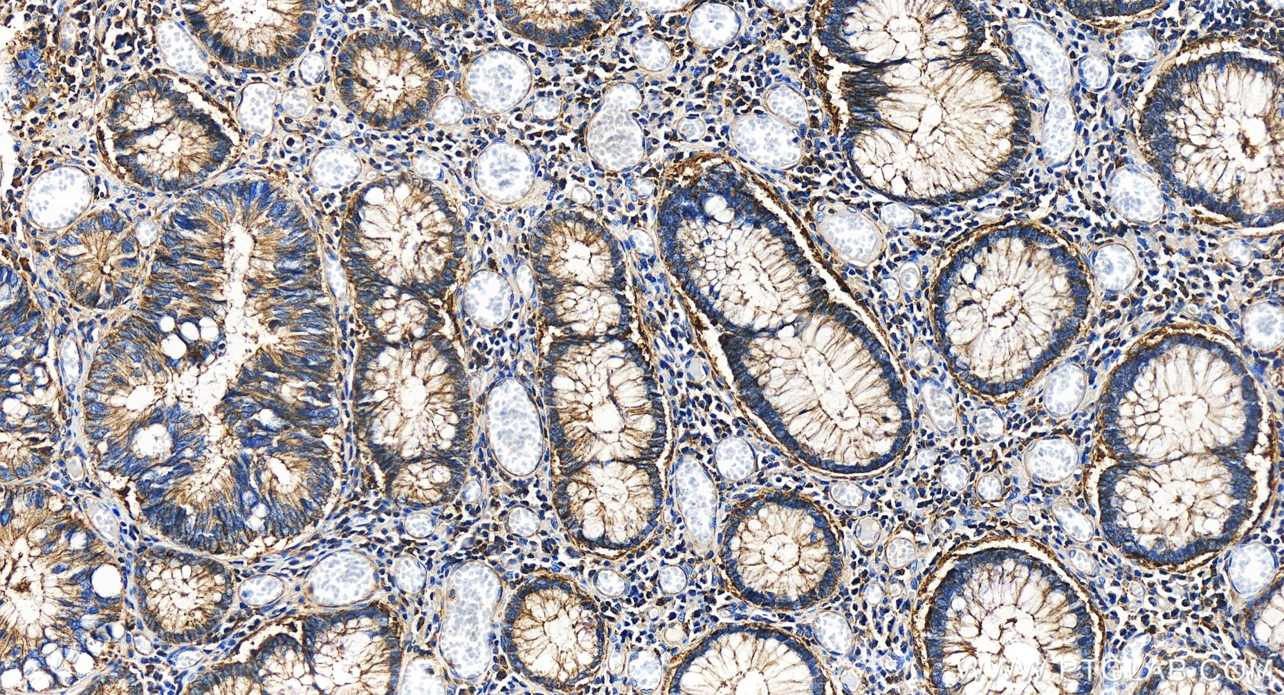 IHC staining of human colon cancer using 85651-1-RR (same clone as 85651-1-PBS)