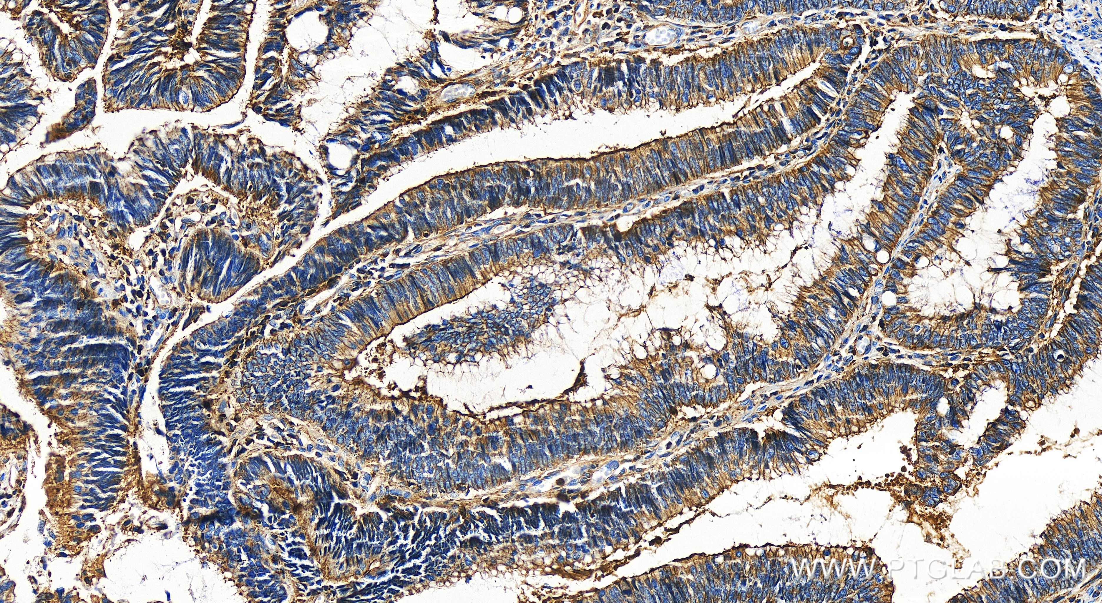 IHC staining of human colon cancer using 85651-1-RR (same clone as 85651-1-PBS)