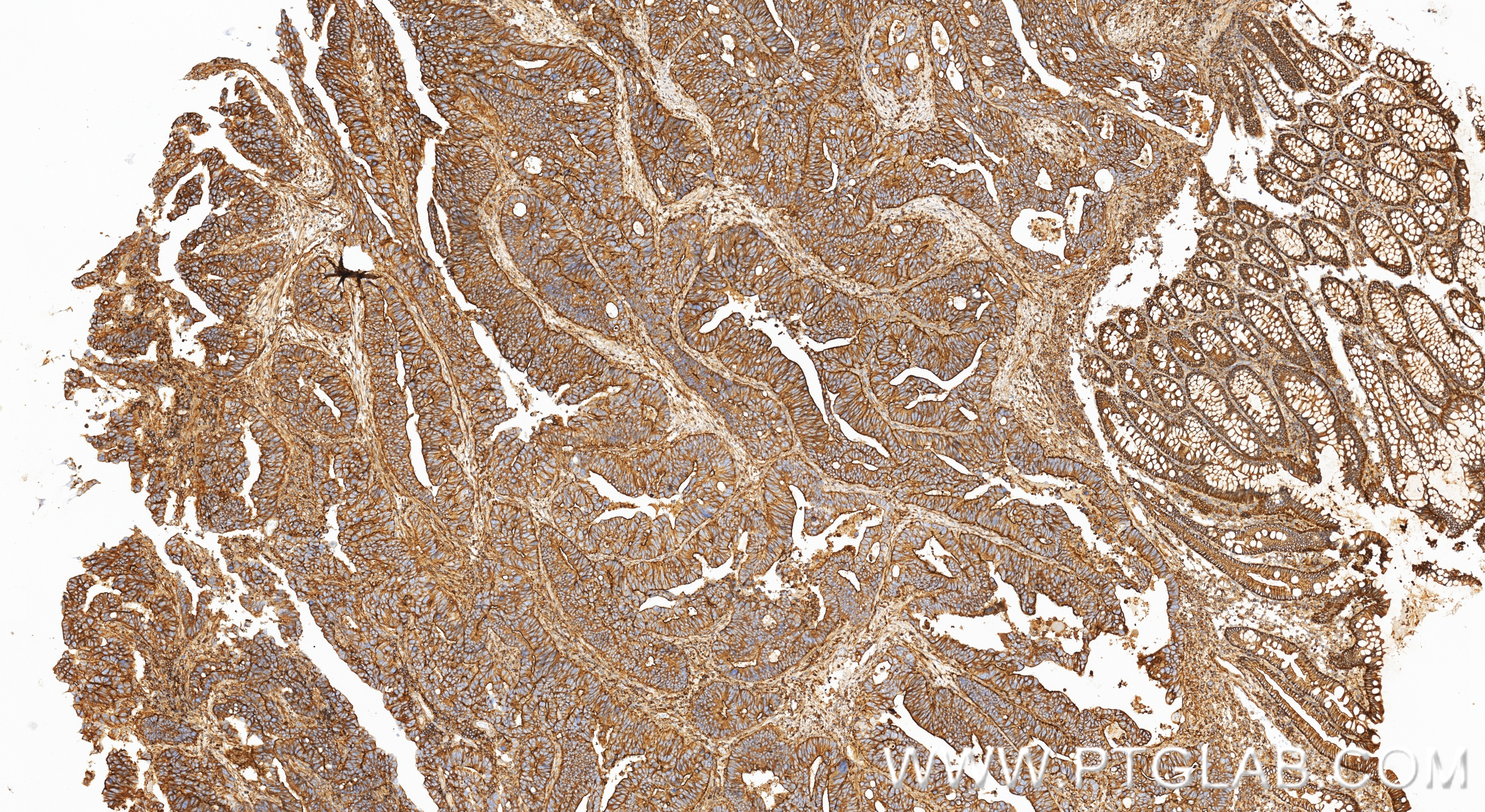 IHC staining of human colon cancer using 85651-1-RR