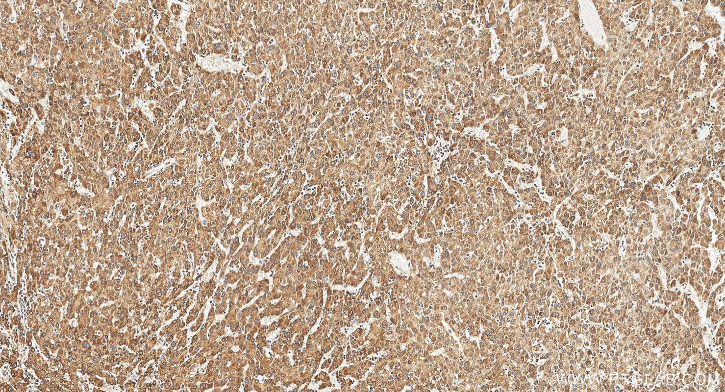 IHC staining of human liver cancer using 55189-1-AP IHC staining of human liver cancer using 55189-1-AP