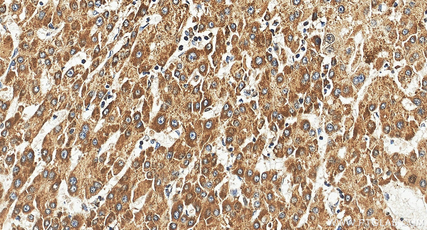 IHC staining of human liver cancer using 55189-1-AP IHC staining of human liver cancer using 55189-1-AP