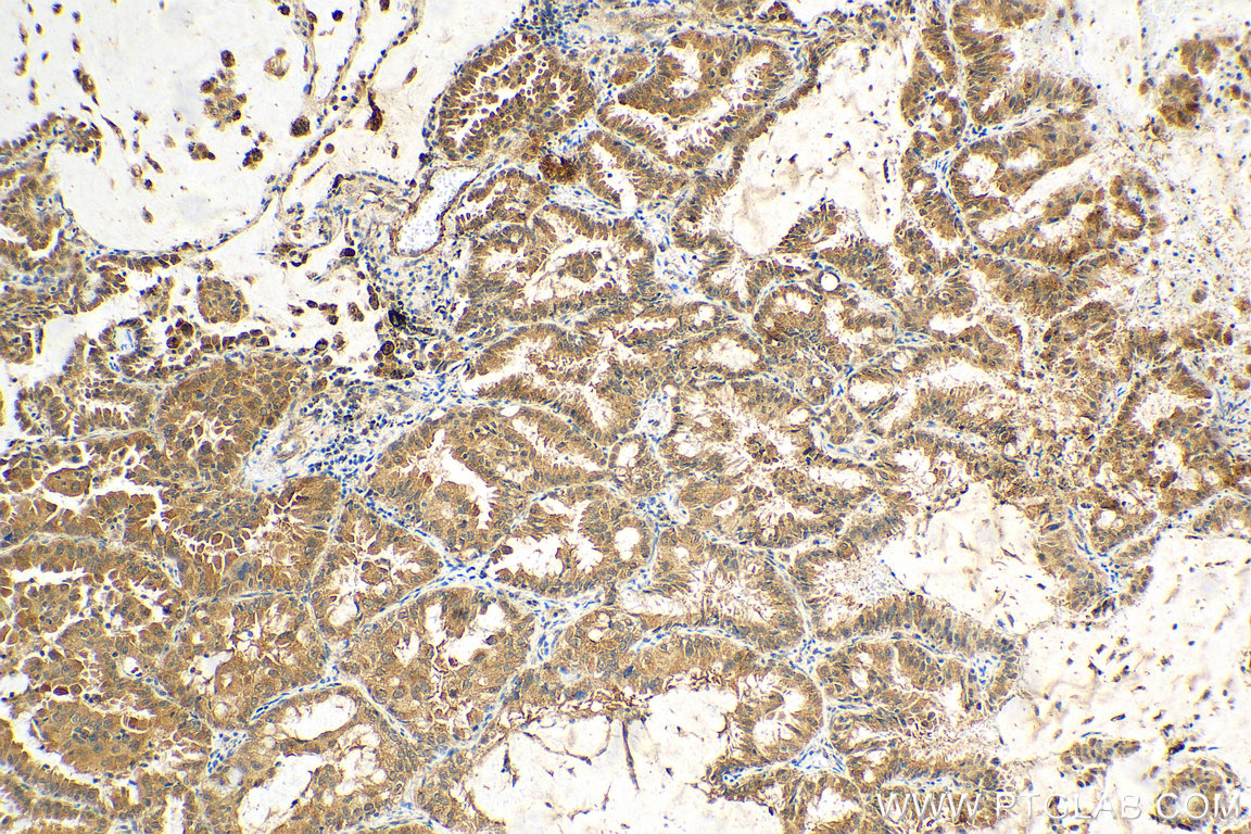 IHC staining of human lung cancer using 10478-2-AP