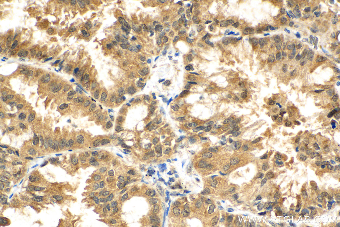 IHC staining of human lung cancer using 10478-2-AP