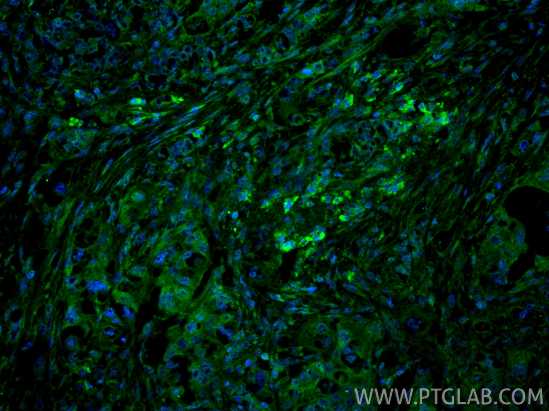 IF Staining of human lung cancer using 18221-1-AP IF Staining of human lung cancer using 18221-1-AP