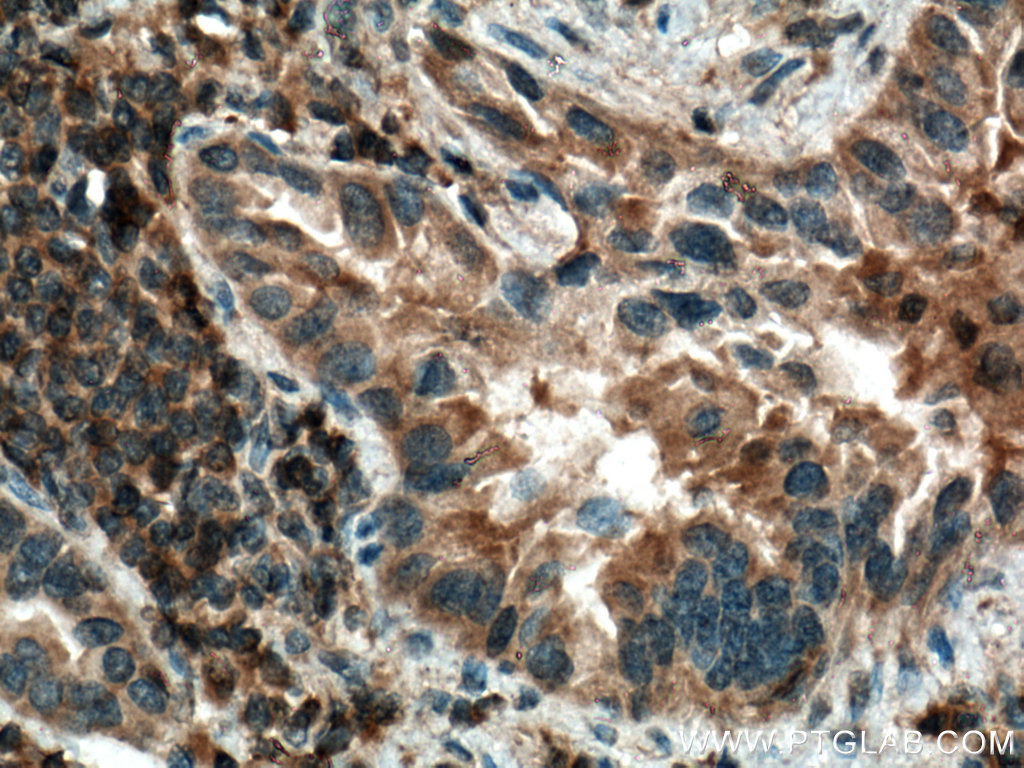 IHC staining of human lung cancer using 18221-1-AP