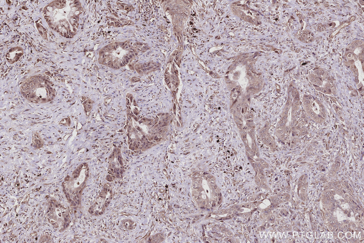 IHC staining of human pancreas cancer using 67180-1-Ig