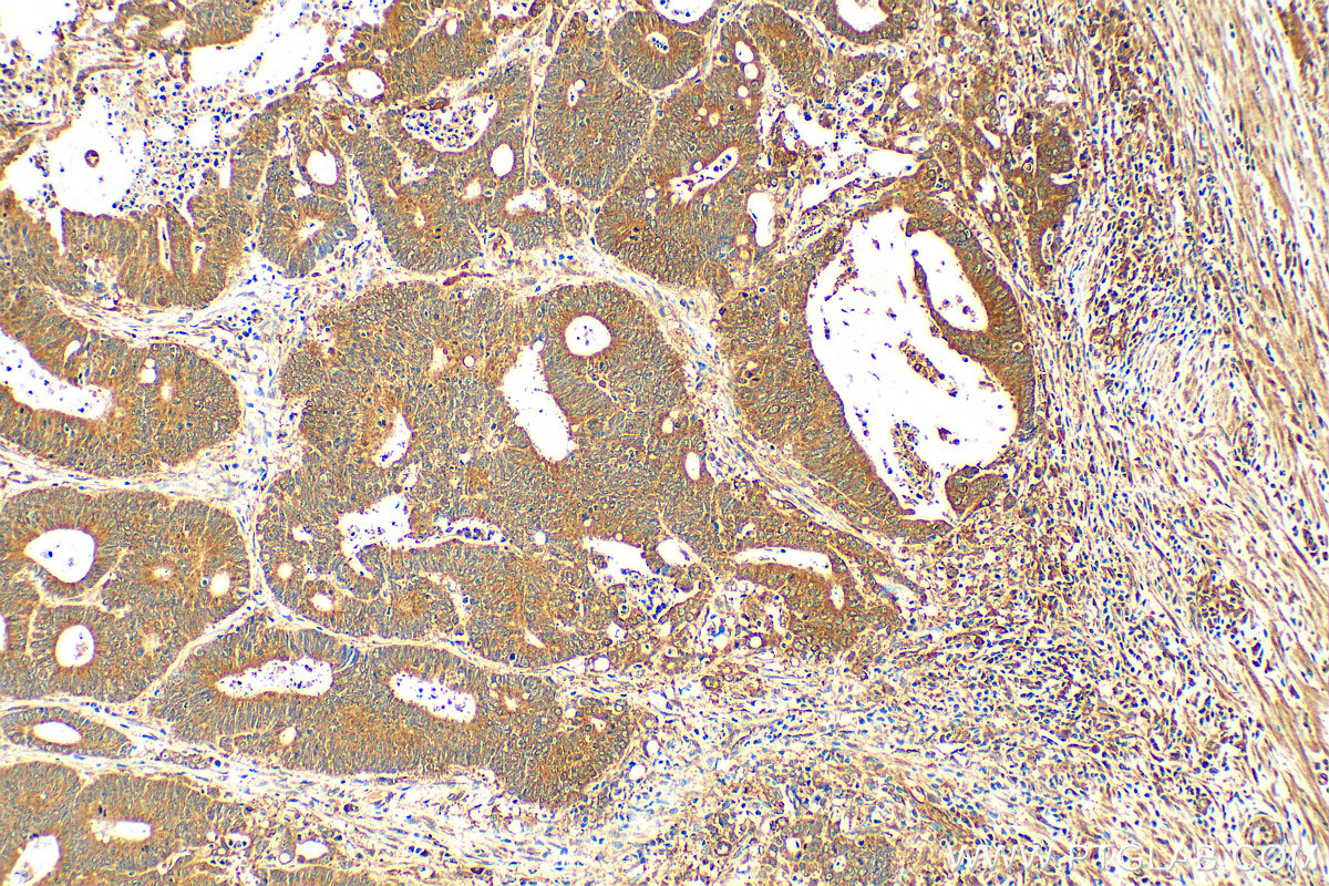 IHC staining of human colon cancer using 29976-1-AP