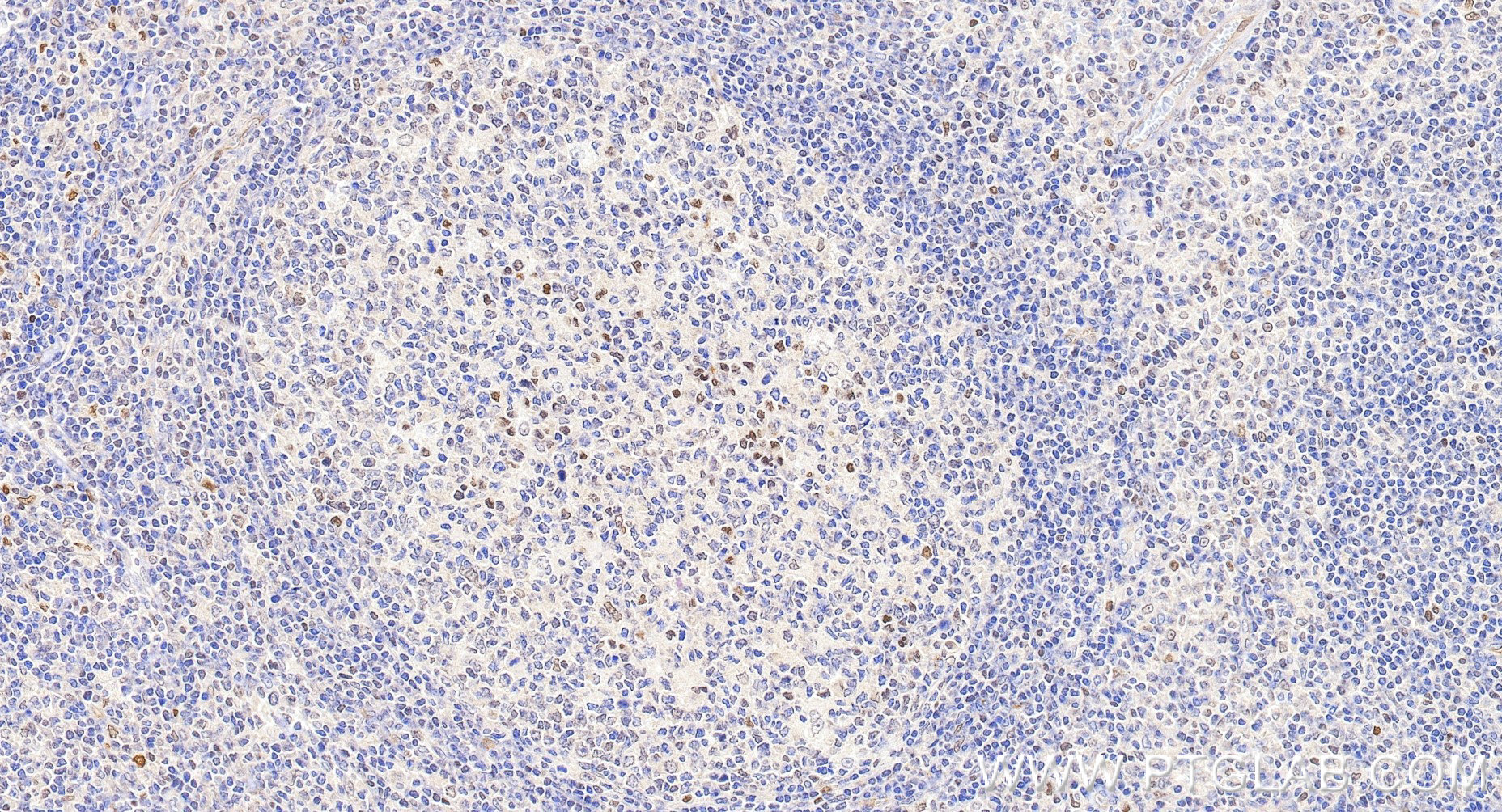 IHC staining of human tonsillitis using 85254-3-RR