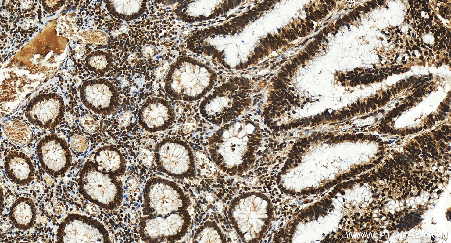 IHC staining of human colon cancer using 12525-1-AP
