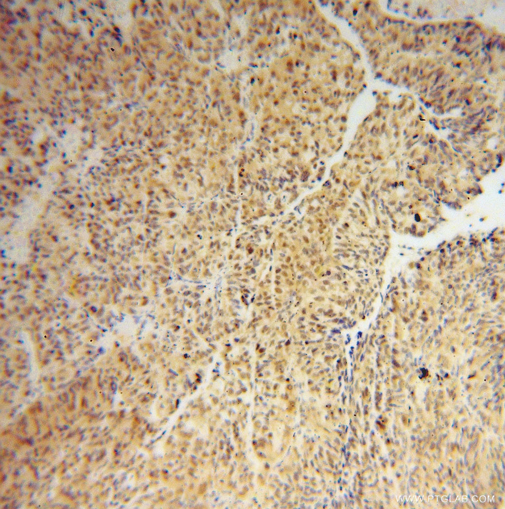 IHC staining of human colon cancer using 12525-1-AP