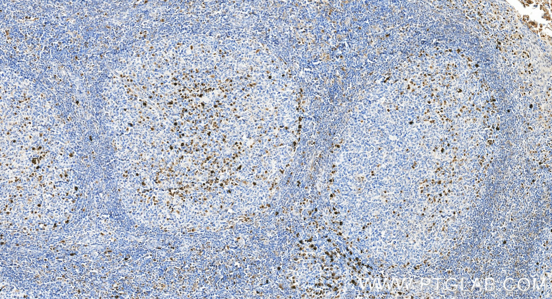 IHC staining of human tonsillitis using 87342-1-RR (same clone as 87342-1-PBS)