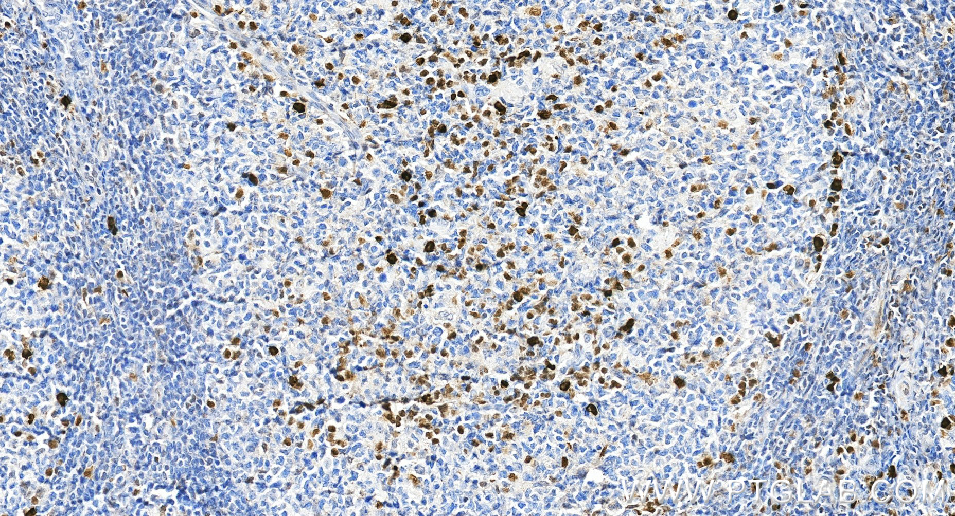 IHC staining of human tonsillitis using 87342-1-RR (same clone as 87342-1-PBS)