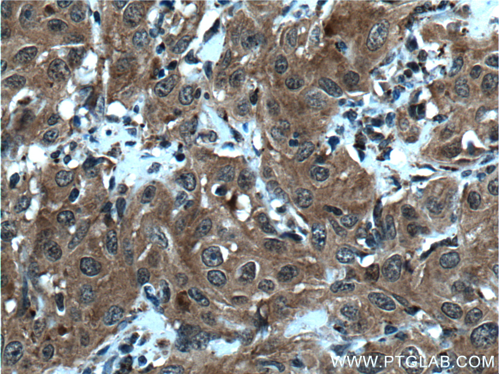 IHC staining of human cervical cancer using 14167-1-AP