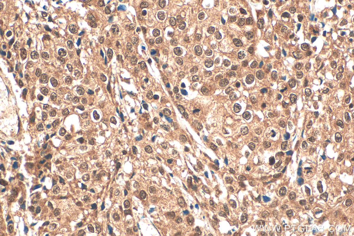 Immunohistochemical analysis of paraffin-embedded human cervical cancer tissue slide using 14167-1-AP (IRF9 antibody) at dilution of 1:200 (under 40x lens). Heat mediated antigen retrieval with Tris-EDTA buffer (pH 9.0). IHC staining of human cervical cancer using 14167-1-AP