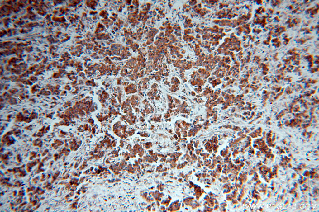 IHC staining of human breast cancer using 17509-1-AP