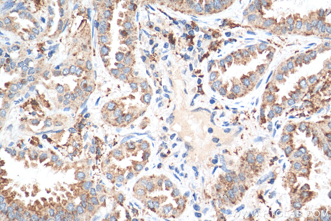 IHC staining of human lung cancer using 15981-1-AP