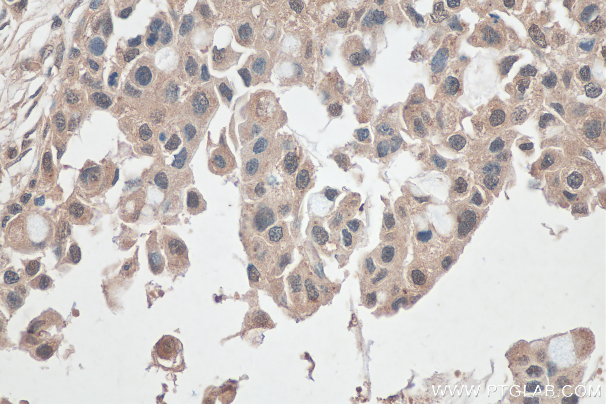 IHC staining of human breast cancer using 20920-1-AP