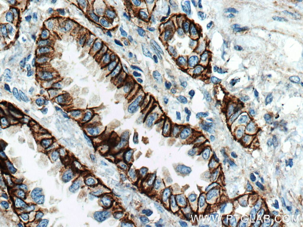 IHC staining of human lung cancer using 66070-1-Ig (same clone as 66070-1-PBS)