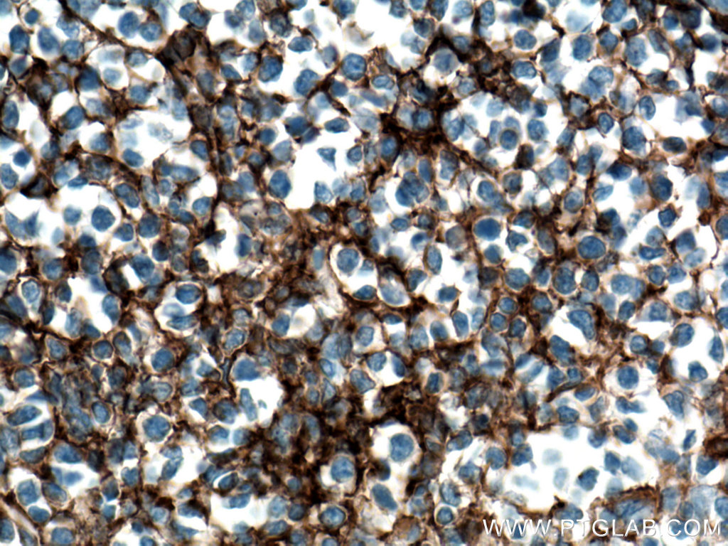 IHC staining of human tonsillitis using 21851-1-AP