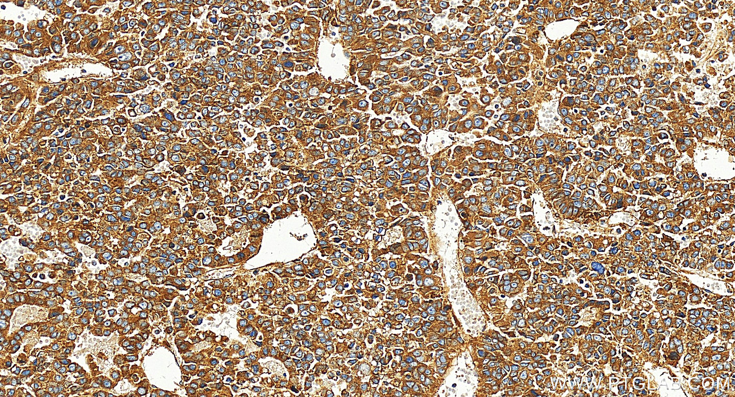 IHC staining of human Hepatocellular carcinoma using 27096-1-AP