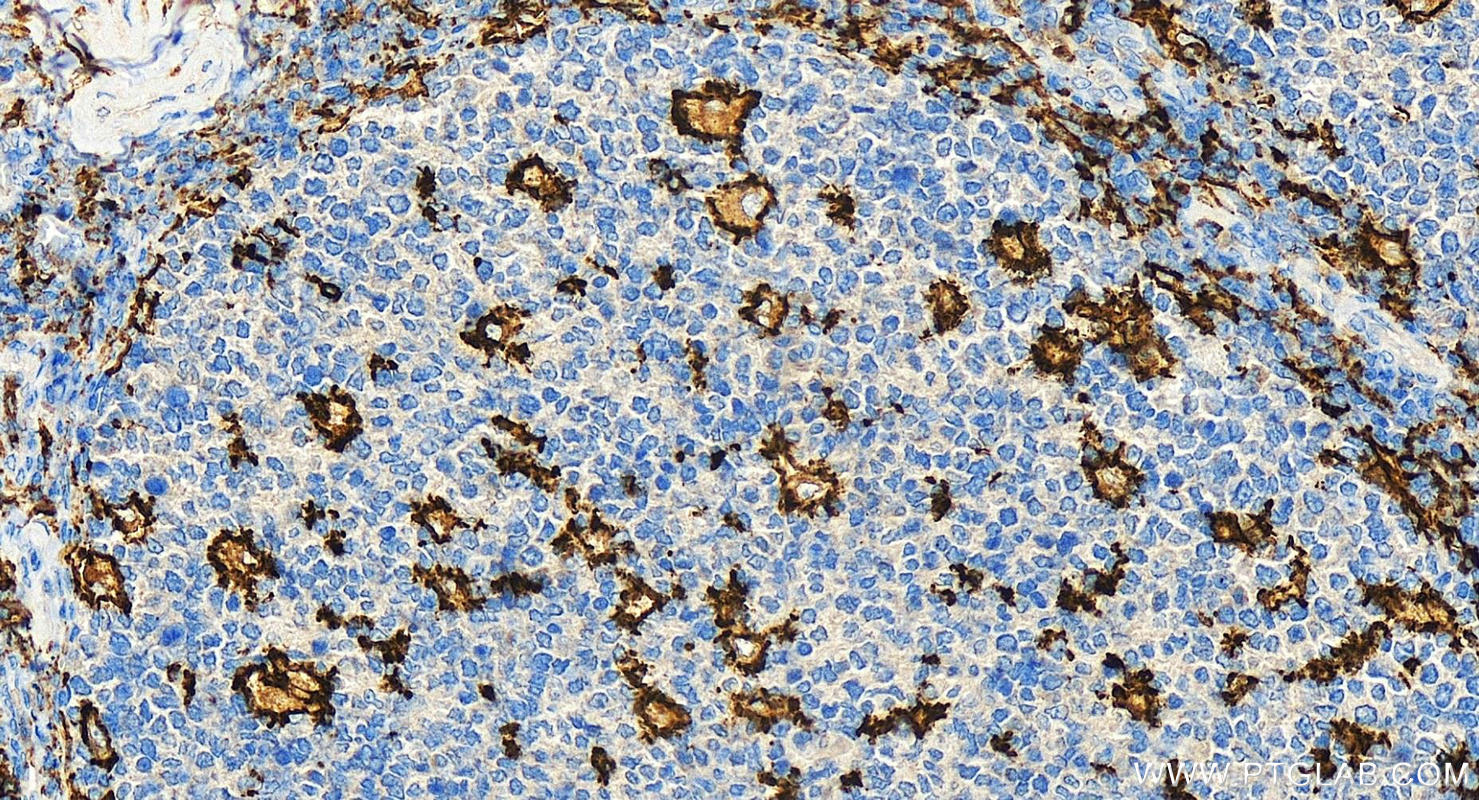 IHC staining of human tonsillitis using 17342-1-AP
