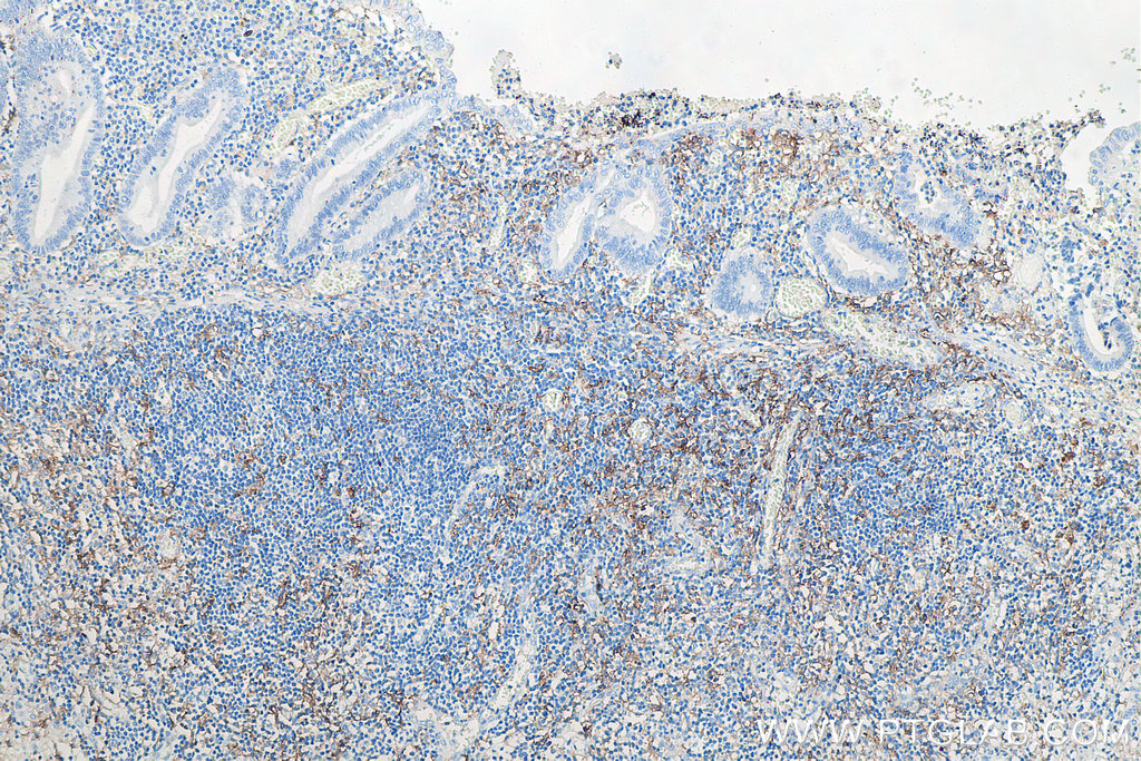 IHC staining of human appendicitis using 60258-1-Ig