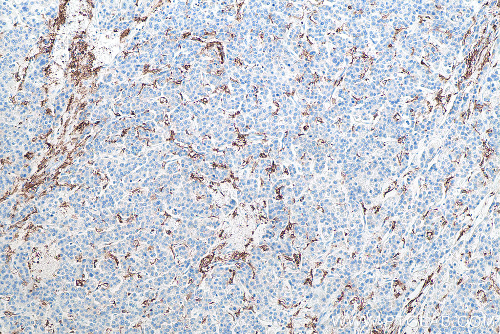 IHC staining of human liver cancer using 60258-1-Ig