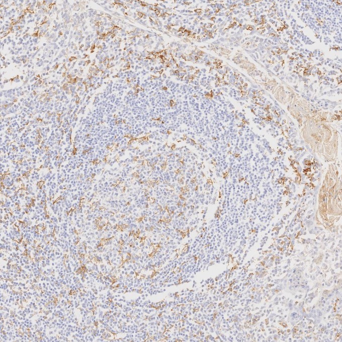 IHC staining of human tonsillitis using 60258-1-Ig