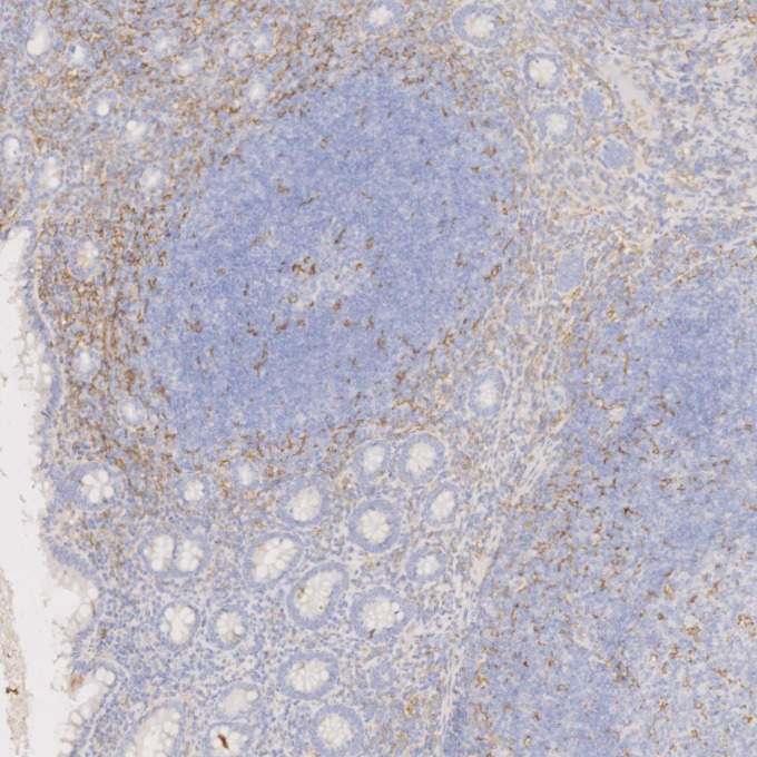 IHC staining of human appendicitis using 60258-1-Ig