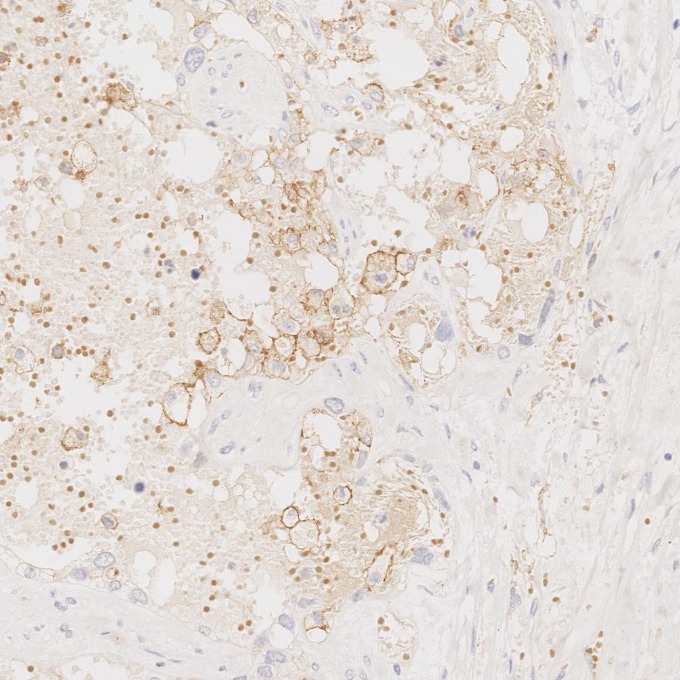 IHC staining of human ovary cancer using 60258-1-Ig