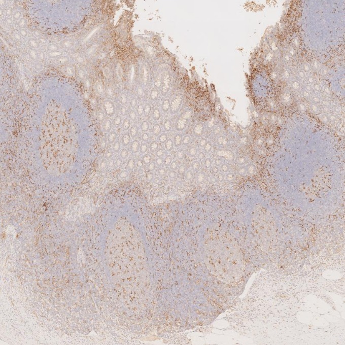 IHC staining of human appendicitis using 60258-1-Ig