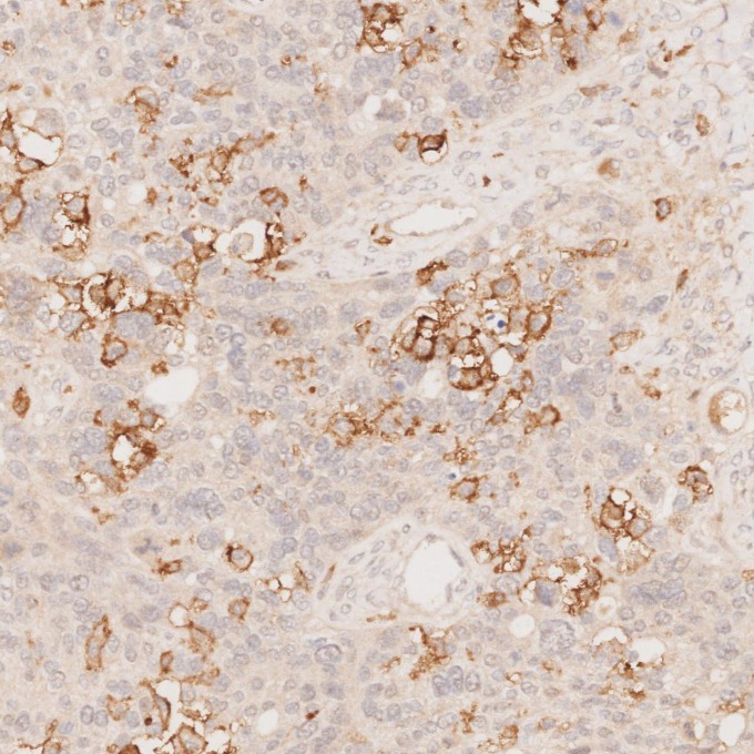 IHC staining of human ovary cancer using 60258-1-Ig