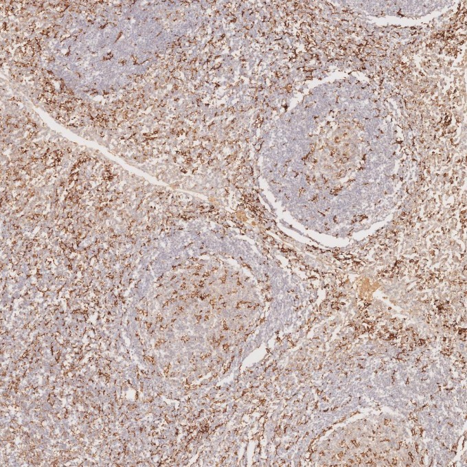 IHC staining of human tonsillitis using 60258-1-Ig