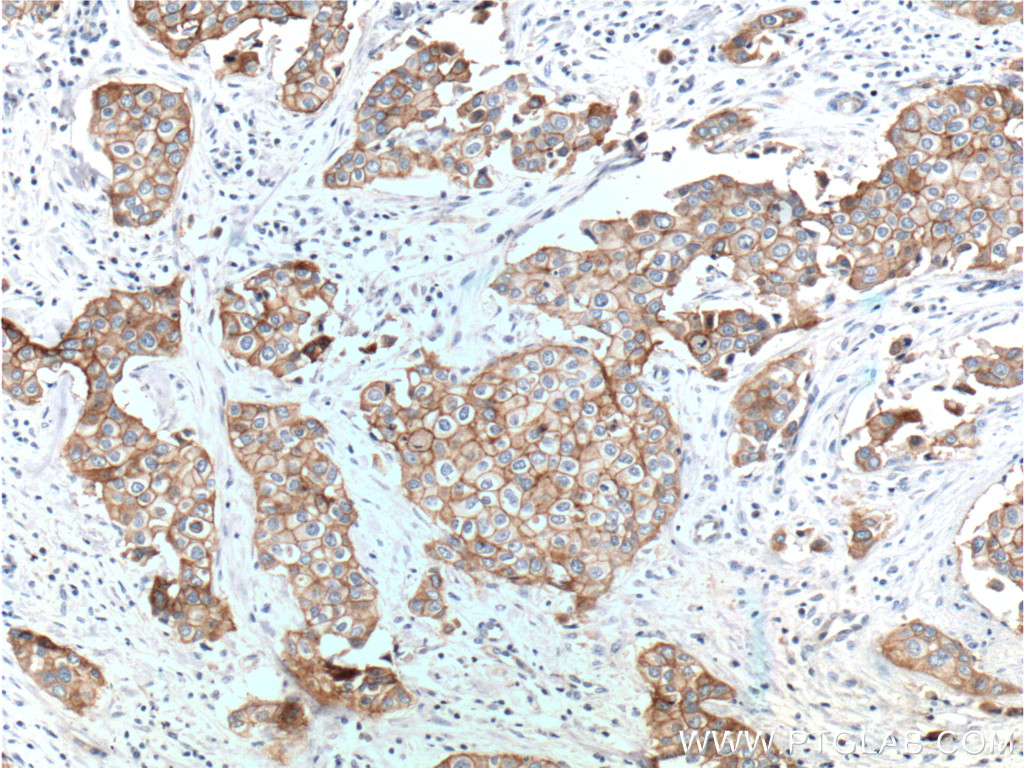 IHC staining of human breast cancer using 25277-1-AP