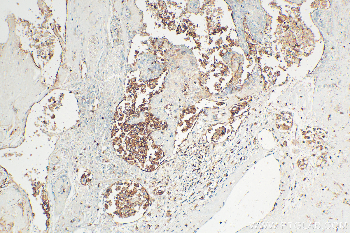 IHC staining of human ovary tumor using 21703-1-AP