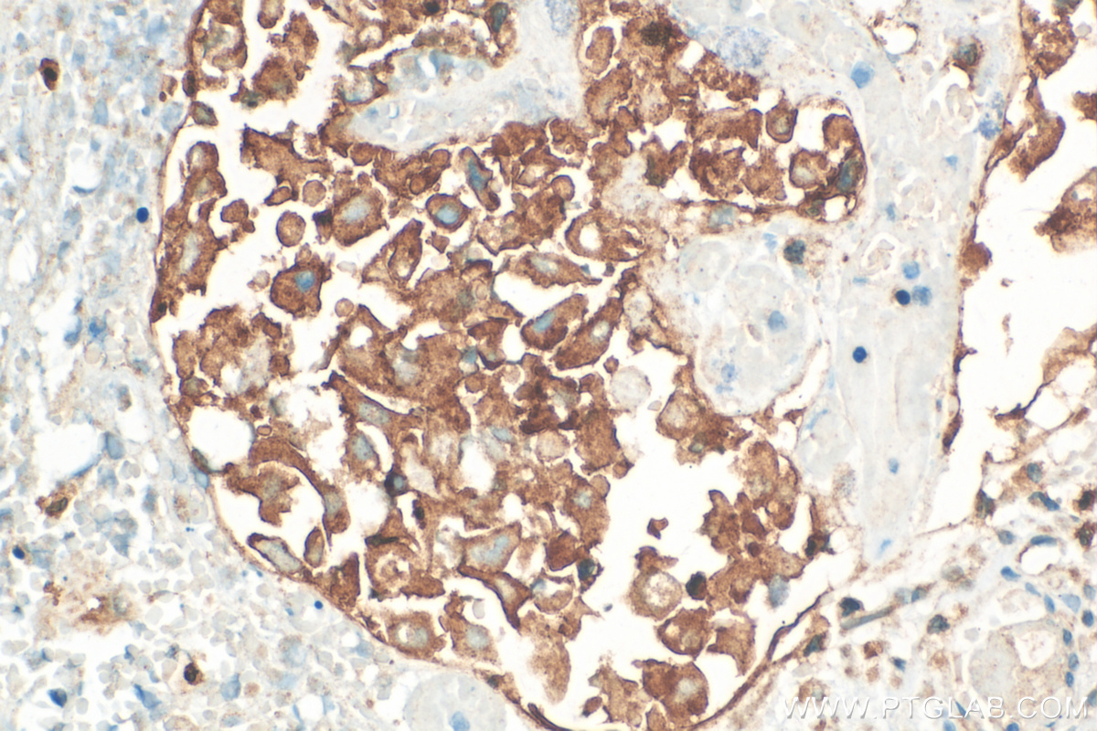 IHC staining of human ovary tumor using 21703-1-AP