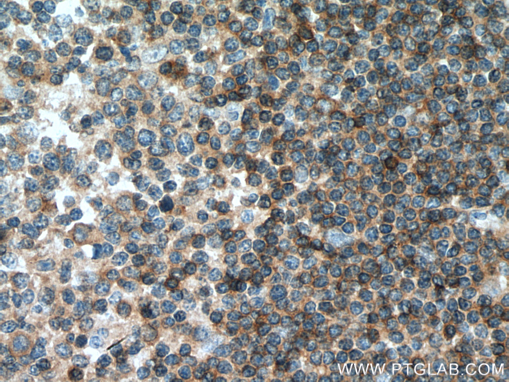 IHC staining of human tonsillitis using 11328-1-AP